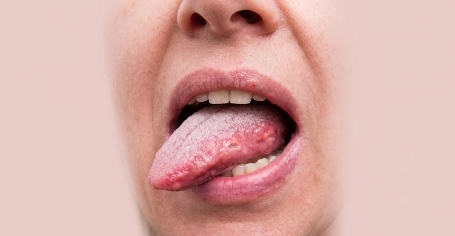 Tongue Cancer inblog